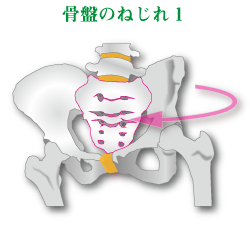 骨盤の左傾イメージ図