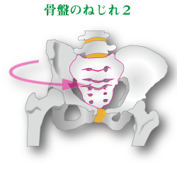 骨盤の右傾イメージ図